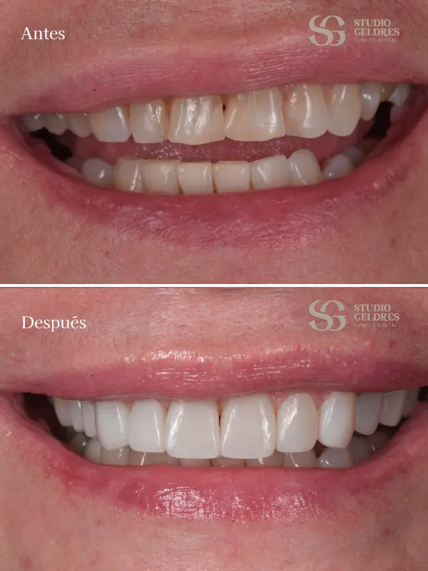 Resultados reales de mejora dental en nuestra clínica dental en Lima