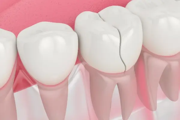 Cómo se diagnostican las microfisuras dentales