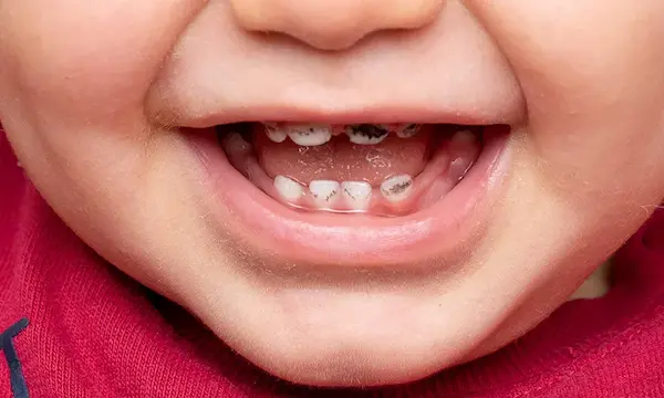 Dientes negros en niños