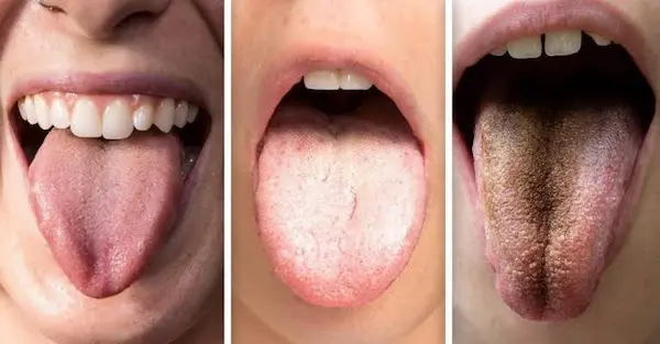 Los 7 colores de lengua y lo que significan