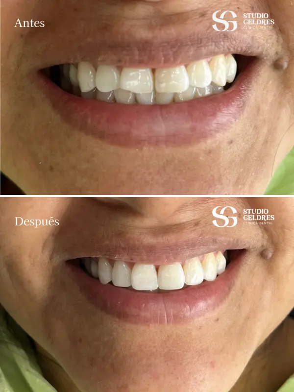Obtén la sonrisa perfecta con nuestra estética dental