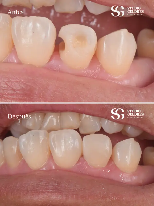 Obtén la sonrisa perfecta con nuestros especialistas en estética dental