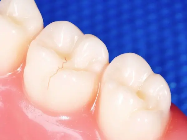 Por qué aparecen las microfisuras dentales