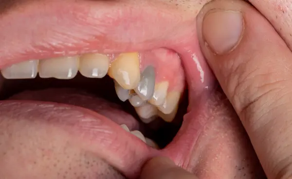 Por qué se ponen negros los dientes