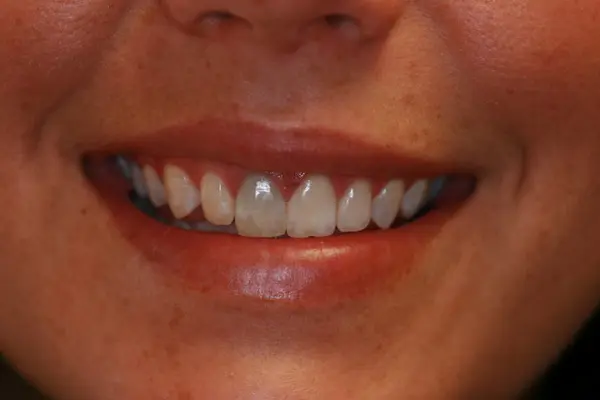 Preguntas frecuentes sobre los dientes negros