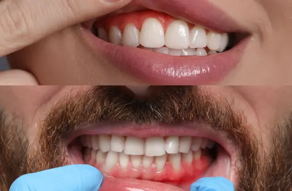 Qué hacer cuando tienes sensibilidad dental