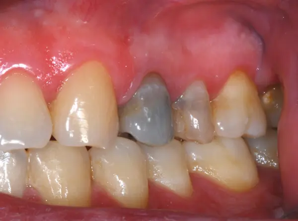 Qué son los dientes negros