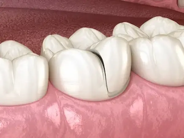 Se pueden prevenir las microfisuras dentales