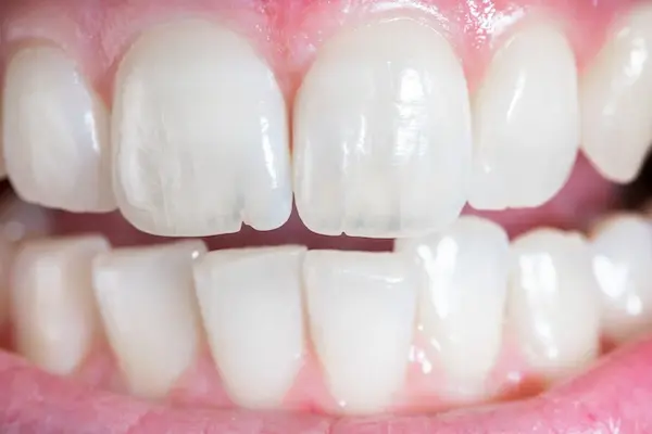 cómo saber si tienes microfisuras dentales