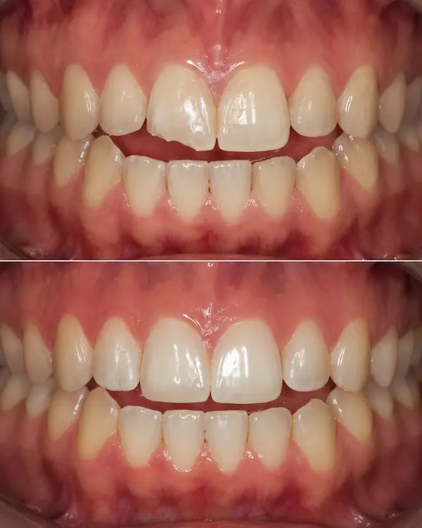 Curaciones con resina y aislamiento absoluto para conservar la estructura dental