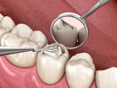 Fracturas y bordes desgastados