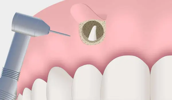 Qué es la microcirugía apical