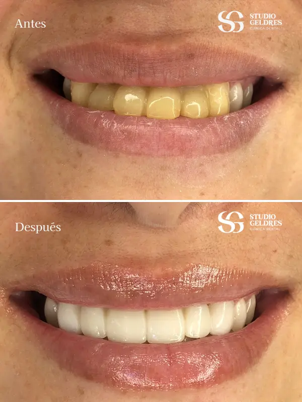 Sonrisas restauradas con coronas dentales en Lima