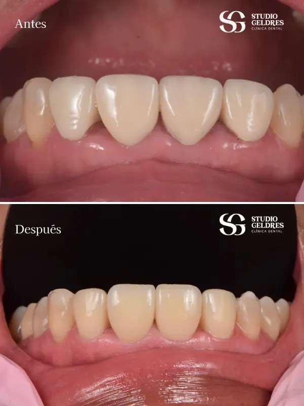 Sonrisas restauradas, función recuperada con coronas dentales