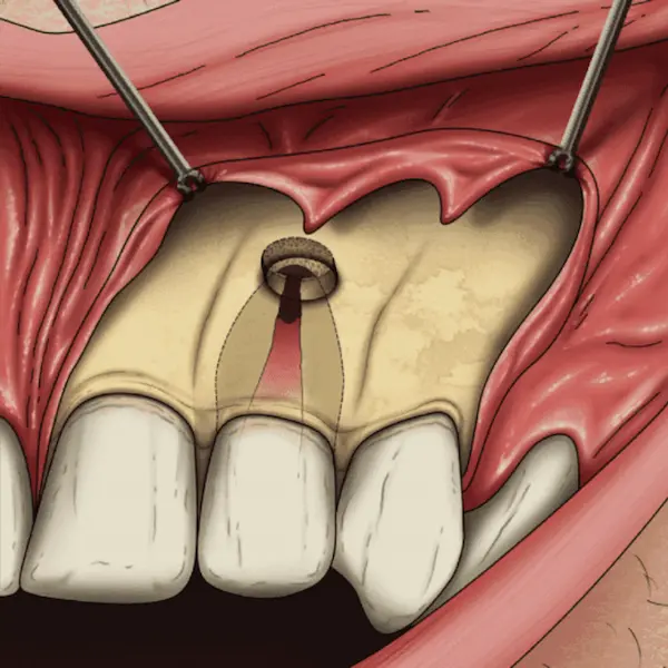 ¿Microcirugía apical y apicectomía son lo mismo