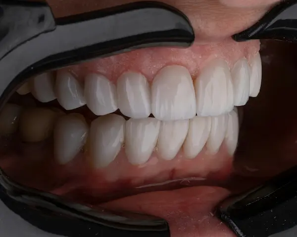 ¿Qué es una maloclusión dental