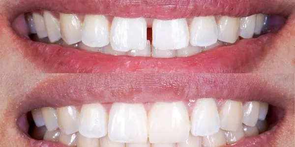 Cómo se pueden corregir los dientes separados