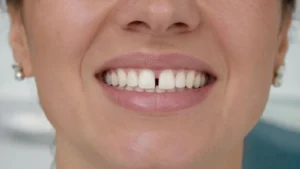 Dientes separados en adultos Causas y cómo tratarlos