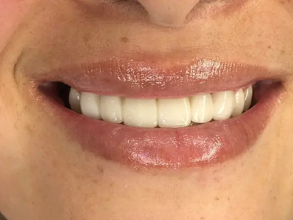 Diferencias entre ortodoncia, resina y carillas para dientes separados