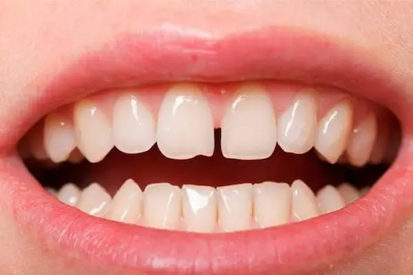 Por qué se están separando mis dientes si antes estaban juntos