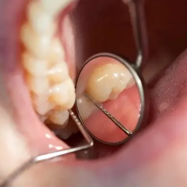 Procedimientos avanzados para la periodontitis crónica
