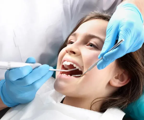 Sellantes dentales infantiles